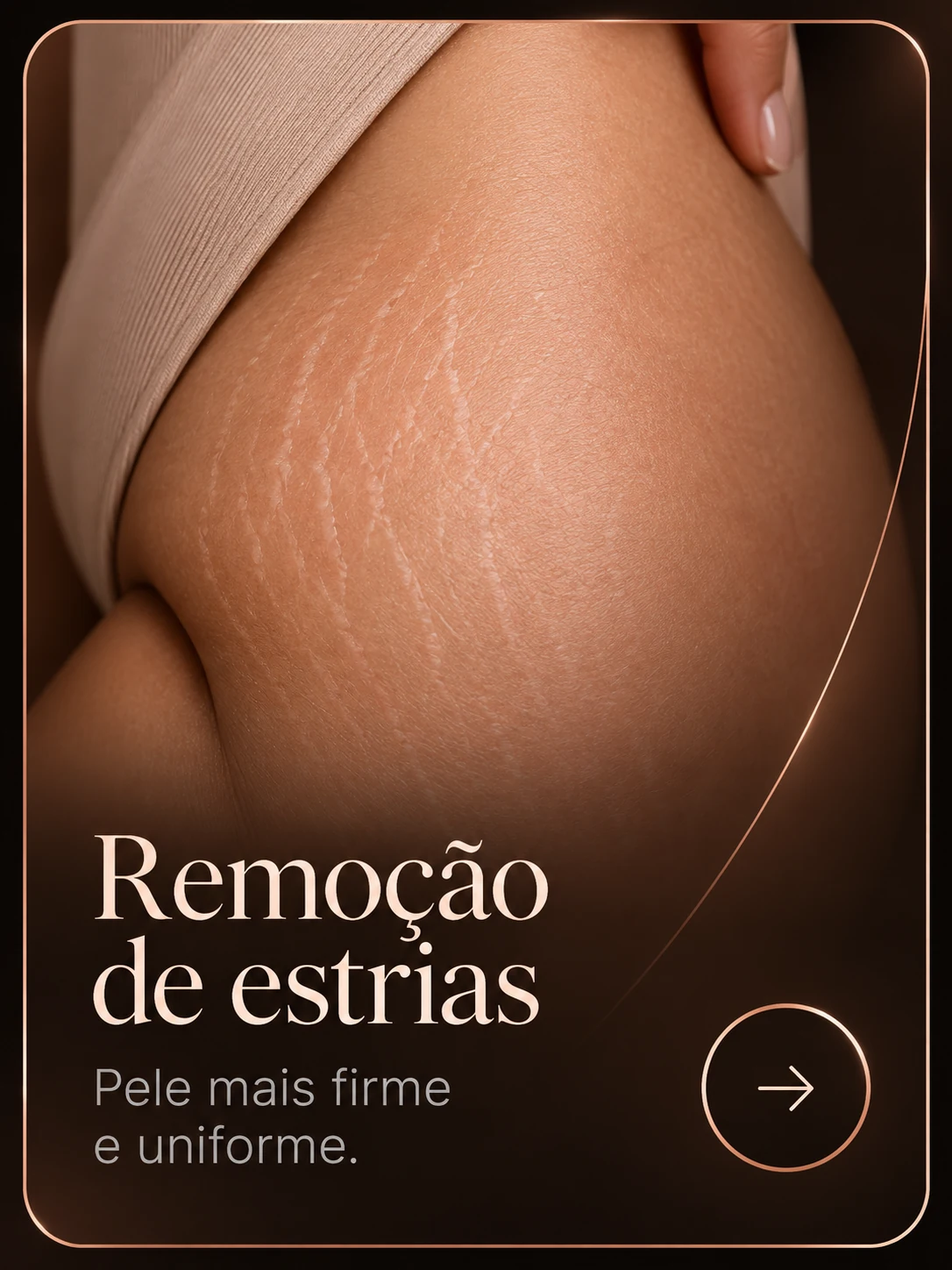 Remoção de estrias — pele mais firme e uniforme