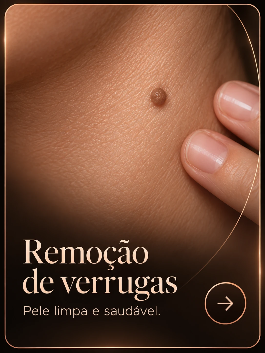 Remoção de verrugas